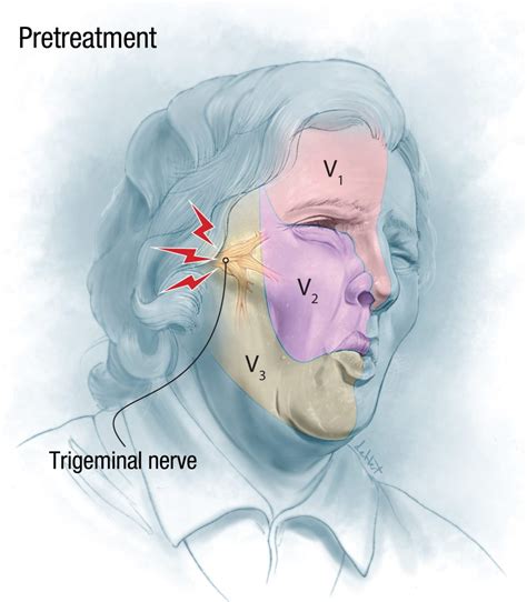 Microvascular decompression of trigeminal neuralgia in a patient with 2 prior gamma knife ...