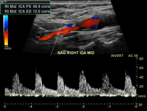 Carotid-artery-dissection-ultrasound - Vascular Medicine - Angiologist