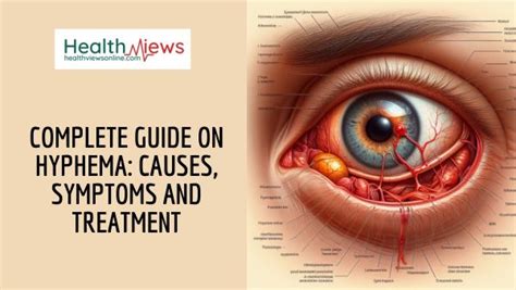 Complete Guide on Hyphema: Causes, Symptoms and Treatment