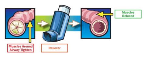 Salbutamol | Healthify