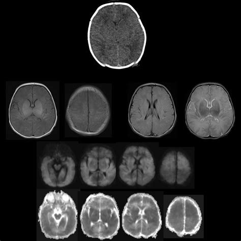 Newborn with a nuchal cord | Pediatric Radiology Case | Pediatric ...