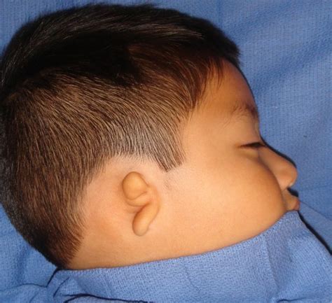 Right Ear Microtia and Atresia before Medpor | Ear Community