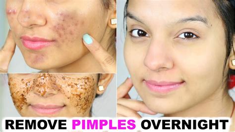 Remove Pimples OVERNIGHT | 100% Success | Anaysa - YouTube