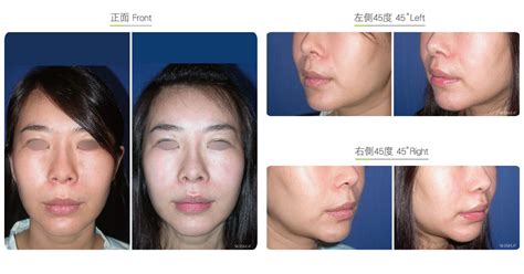 Philtrum Reduction-Facial Surgery | Wish Aesthetic Surgery Clinic