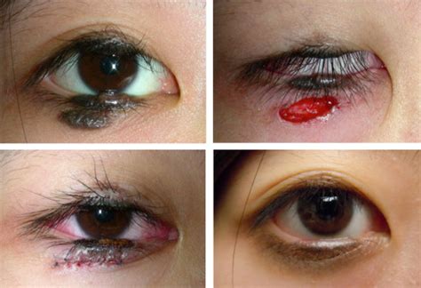 Divided Eyelid Nevus: A Lid-Sparing, Staged Surgical Approach | Ento Key