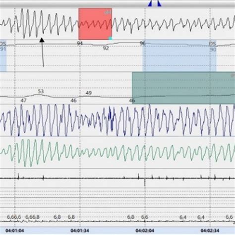 (PDF) First Description of the Hyperpnea–Hypopnea Periodic Breathing in Patients with ...