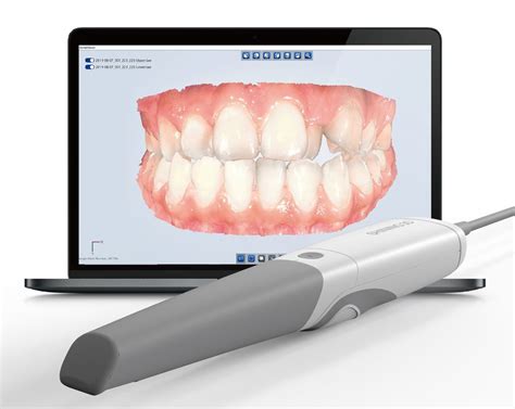 Shining 3D’s Aoralscan 3 Intraoral Scanner Loaded with New Features