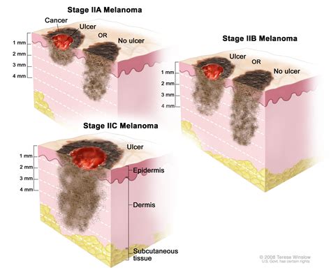 Stage 4 Melanoma Cancer