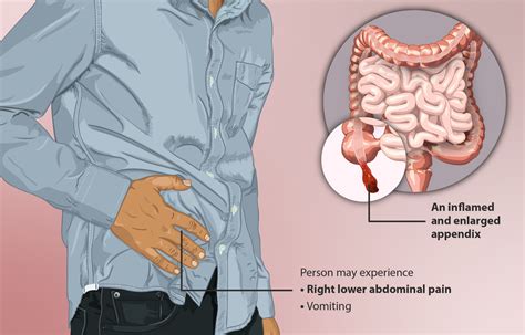 Appendicitis: Surgical vs. Medical Treatment