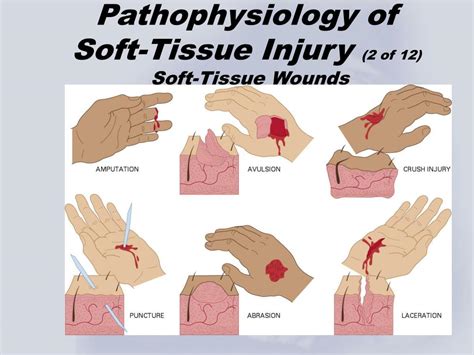 PPT - Chapter 5 Soft-Tissue Trauma PowerPoint Presentation, free ...