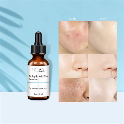 Salicylic Acid Serum 30ml