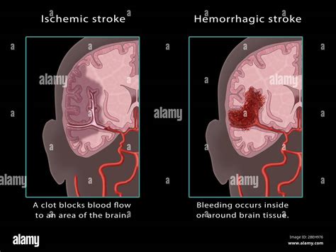 Ischemic & Hemorrhagic Stroke, Illustration Stock Photo - Alamy