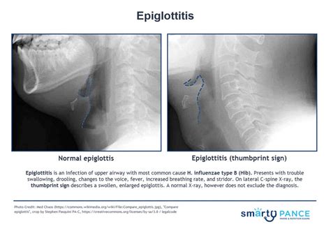 Swollen Epiglottis Treatment