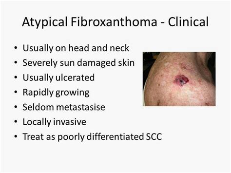 Dermpath Made Simple - Neoplastic: Atypical Fibroxanthoma