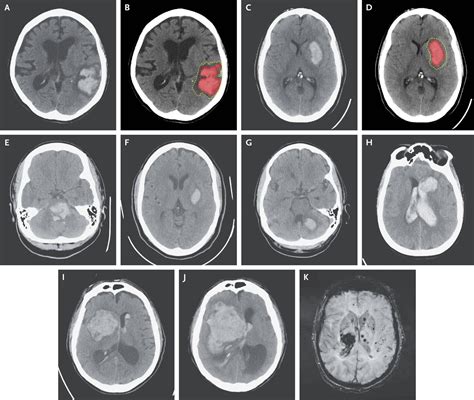 Spontaneous Intracerebral Hemorrhage | New England Journal of Medicine