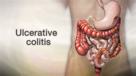 ulcerative colitis in babies - Daryl Olmstead