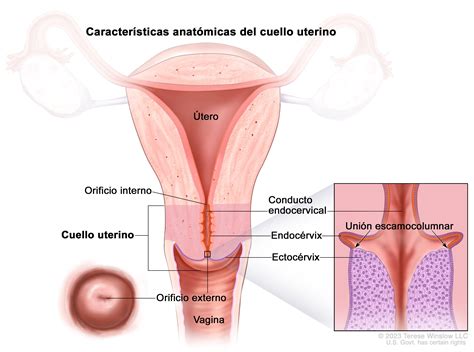 ¿Qué es el cáncer de cuello uterino?