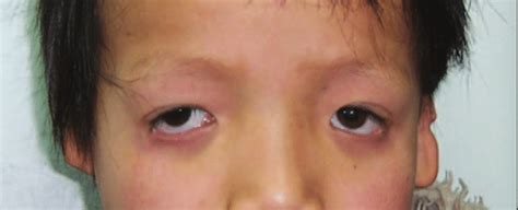 Patient 1 had slanting palpebral fissures, coloboma of the eyelid,... | Download Scientific Diagram