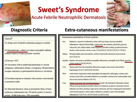 Sweet's Syndrome - Acute Febrile Neutrophilic Dermatosis