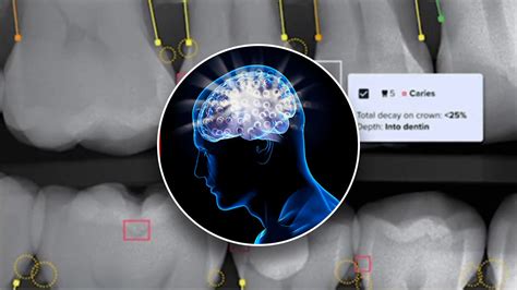 AI game-changer makes leaps toward future by detecting dental diseases earlier than ever ...