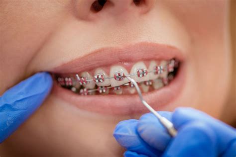 Understanding Orthodontic Braces | Lancaster Orthodontist