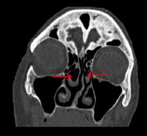 Bilateral concha bullosa with domination of the right concha (red arrows). | Download Scientific ...