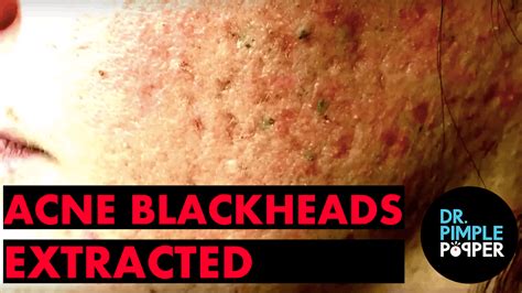 Acne & Blackheads extracted by Dr. Sandra Lee - Blackheads & Whiteheads Galore - Dr. Pimple Popper