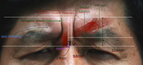 #1-2. Upper Face: Forehead & Glabella | D&PS | Botox, Botox forehead ...