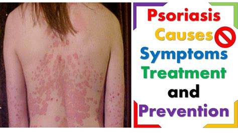What is Psoriasis causes Symptoms treatment and prevention - YouTube