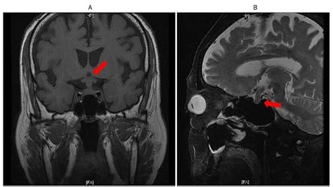 Brain MRI on June 2. A: Coronal section. B: Sagittal section. Note the ...