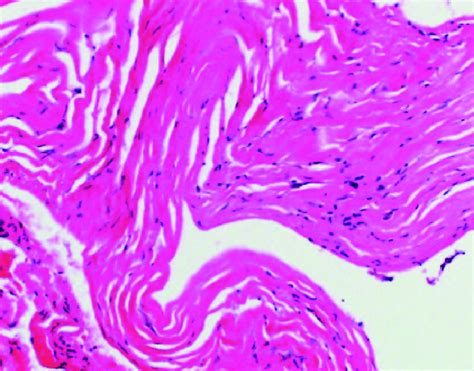 Histopathological examination confirmed the presence of fibrous tissue ...