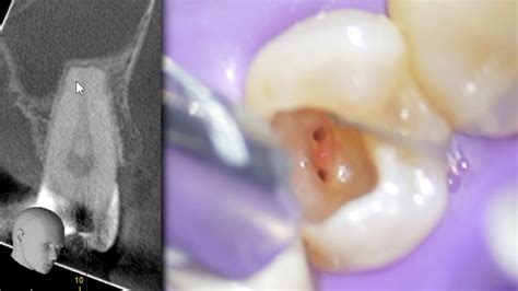 LIVE Premolar Root Canal w/ Endodontist | Caries Directed Access - YouTube