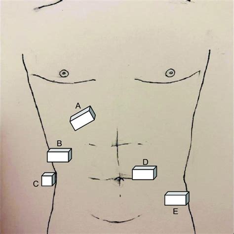 Ultrasound image of the paravertebral block in transverse approach ...