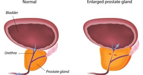 Transurethral Resection Of The Prostate - TURP Procedure