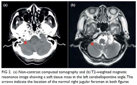 Jugular Foramen Mri