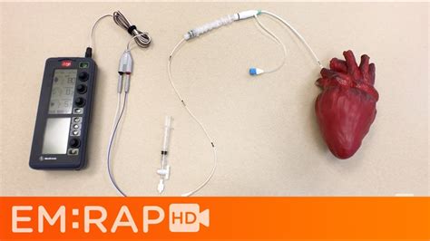 transmission Diacritical Strait transvenous pacing settings funnel Sui ...