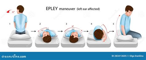 Epley Maneuver Left Ear Affected Vector Illustration Stock Vector - Illustration of head, bppv ...