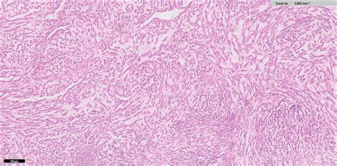 -Microscopic pathology of the mucinous tubular and spindle cell... | Download Scientific Diagram