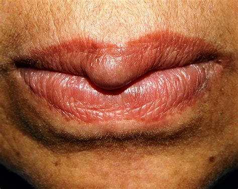 Angioleiomyoma of the upper lip | BMJ Case Reports