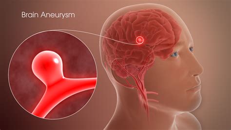 Brain Aneurysm Shown & Explained Using A 3D Medical Animation