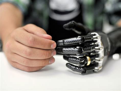 26-year-old woman receives BeBionic, the world's most advanced, natural prosthetic hand