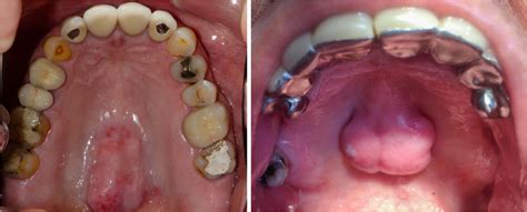 Palatal torus: etiology, clinical aspect, and therapeutic strategy | Journal of Oral Medicine ...