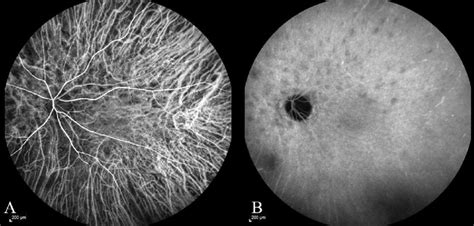 Case 8: A. ICG angiography at 21 seconds. B. ICG angiography at 18... | Download Scientific Diagram