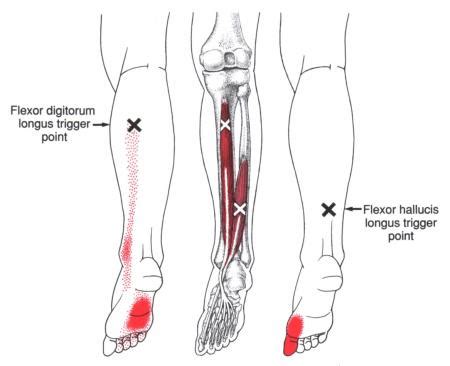 Flexor Digitorum Longus | The Trigger Point & Referred Pain Guide