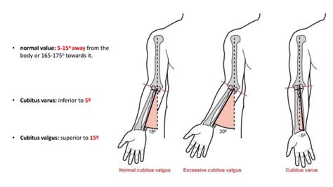 Cubitus valgus varus