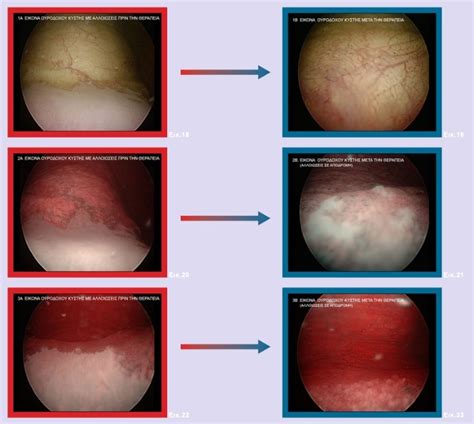 Chronic Cystitis Treatment and Therapy | Georgiadis Urology