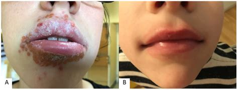 Eczematous Cheilitis