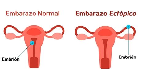 ¿Qué es el embarazo ectópico? - Centro Clínico Fenix Salud