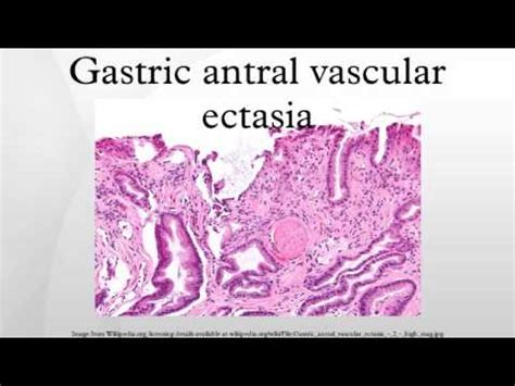 Gastric antral vascular ectasia - YouTube