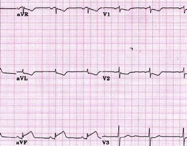 Anteroseptal infarct Symptoms, Cause, ECG/EKG, Treatment